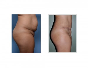 HH Tummy Tuck results side view