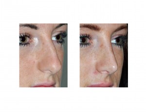 Indianapolis Rhinoplasty Dr Barry Eppley