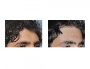 Male Forehead Augmentation result oblique view