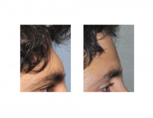 Male Forehead Augmentation result side view