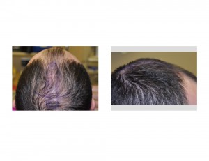 Sagittal Ridge Skull Deformity Dr Barry Eppley Indianapolis