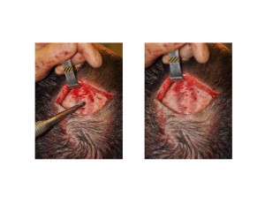 Sagittal Ridge Skull Deformity burring reduction Dr Barry Eppley Indianapolis