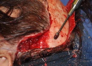 Skull Burring for Head Narrowing Dr Barry Eppley Indianapolis