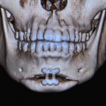 Sliding Genioplasty step off front view Dr Barry Eppley Indianapolis