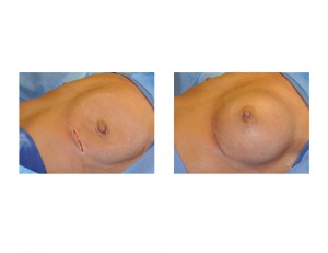 Breast Implant Chest Wall Deformity Dr Barry Eppley Indianapolis