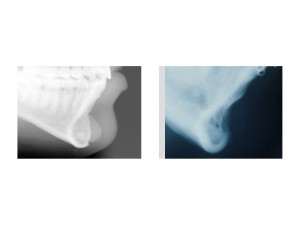 Chin Implant Settling Dr Barry Eppley Indianapolis