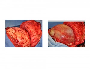 HTR Occipital Implant Augmentation for Flat Back of the Head Dr Barry Eppley Indianapolis