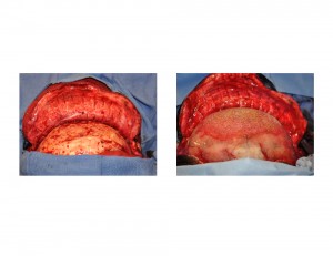HTR Occipital Implant Augmentation result intraop top view Dr Barry Eppley Indianapolis