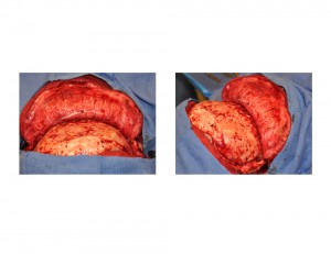 HTR Occipital Implant Scalp Flap Elevation Dr Barry Eppley Indianapolis