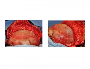 HTR Occipital Implant positioned Dr Barry Eppley Indianapolis