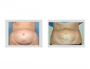 Smartlipo Abdominal Liposuction result front view Dr Barry Eppley Indianapolis
