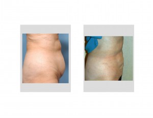 Smartlpo Abdominal Liposuction result side view Dr Barry Eppley Indianapolis