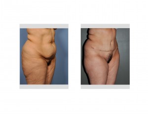 Tummy Tuckj Surgery Indianapolis Dr Barry Eppley