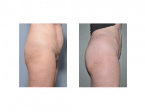 Vertical Tummy Tuck result left side view Dr Barry Eppley Indianapolis
