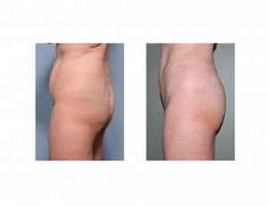Vertical Tummy Tuck result side view Dr Barry Eppley Indianapolis