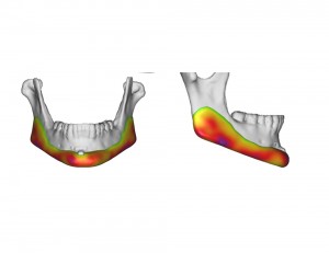 Custom Jawline Implant Indianapolis Dr Barry Eppley