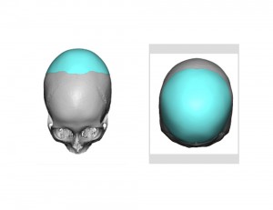 Custom Occipital Implant design 2 Dr Barry Eppley Indianapolis