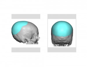 Custom Occipital Implant design Dr Barry Eppley Indianapolis