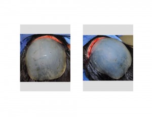 Cusytom Occipital Implant Dr Barry Eppley Indianapolis