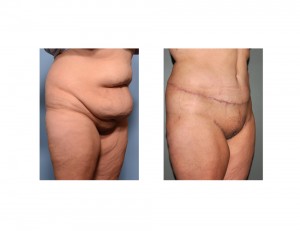 Extdnded Tummy Tuck results oblique view Dr Barry Eppley Indianapolis