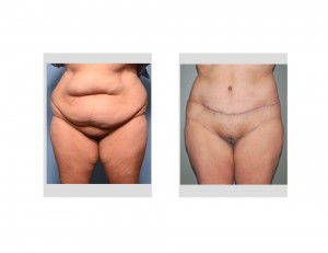 Extended Tummy Tuck result frnt view Dr Barry Eppley Indianapolis