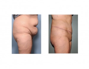 ExtendedTummy Tuck results side view Dr Barry Eppley Indianapolis
