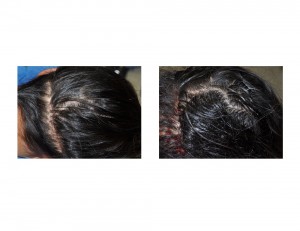 Incision for Custom Occipital Implant Dr Barry Eppley Indianapolis