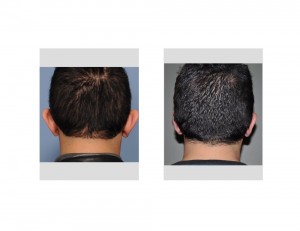 Incisional Otoplasty Indianapolis Dr Barry Eppley