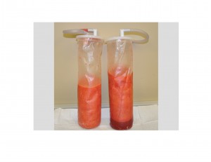 Liposuction Fat Aspirate Dr Barry Eppley Indianapolis