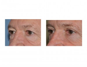 Lower Blepharoplasty with lateral Canthopexy Dr Barry Eppley Indianapolis