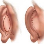 Skin Excision in Otoplasty Dr Barry Eppley Indianapolis