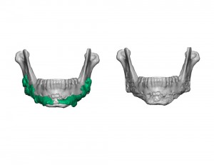 Sliding Genioplasty and HA Granule Jawline Augmentation Dr Barry Eppley Indianapolis