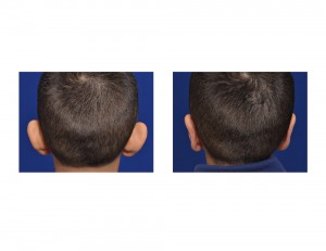 Child Otoplasty result back view