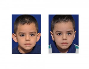 Child Otoplasty result front view