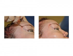 Direct Tail of the Brow Pexy technique 2 Dr Barry Eppley Indianapolis