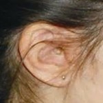 Ear Growth Dr Barry Eppley Indianapolis