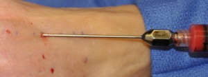 Facial Fat Injections Indianapolis Dr Barry Eppley