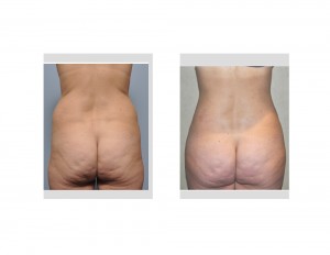 Fat Injection Hip Augmentation Indianapolis Dr Barry Eppley