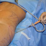 Fat Injections for Hip Augmentation Technique Dr Barry Eppley Indianapolis