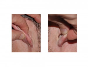 Helical Rim Earlobe Reduction scars Dr Barry Eppley Indianapolis