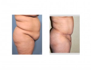 Large Tuck results side view Dr Barry Eppley Indianapolis