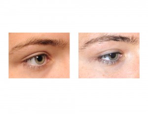 Lateral Canthiopexy result oblique view Dr Barry Eppley Indianapolis
