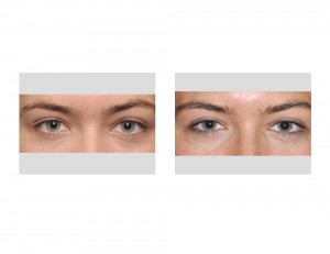 Lateral Canthopexy results Dr Barry Eppley Indianapolis