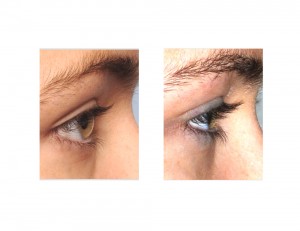 Lateral Canthopexy results side view Dr Barry Eppley Indianapolis