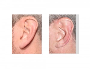 Left Helical Rim Earlobe Reduction result Dr Barry Eppley Indianapolis
