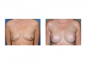 Local Anesthesia BAM result front view