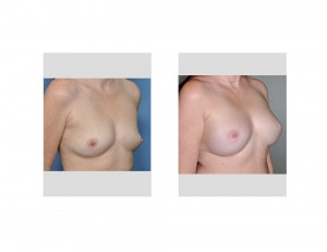 Local Anesthesia BAM result oblique view