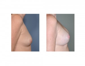 Local Anesthesia BAM result side view