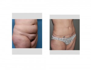 Long Term Tummy Tuck result oblique view Dr Barry Eppley Indianapolis
