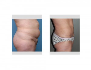 Long Term Tummy Tuck result side view Dr Barry Eppley Indianapolis